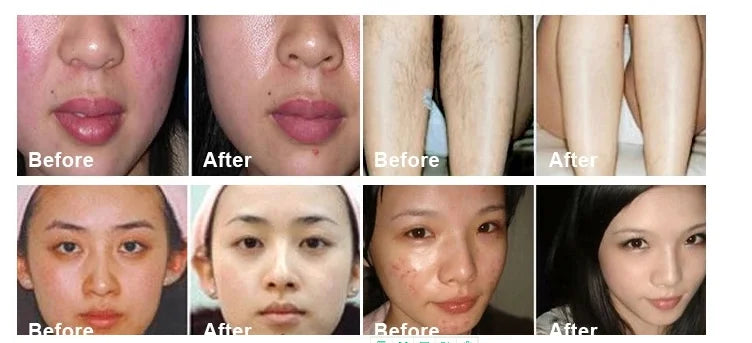 Portable 360 magneto-optical IPL painless hair removal machine