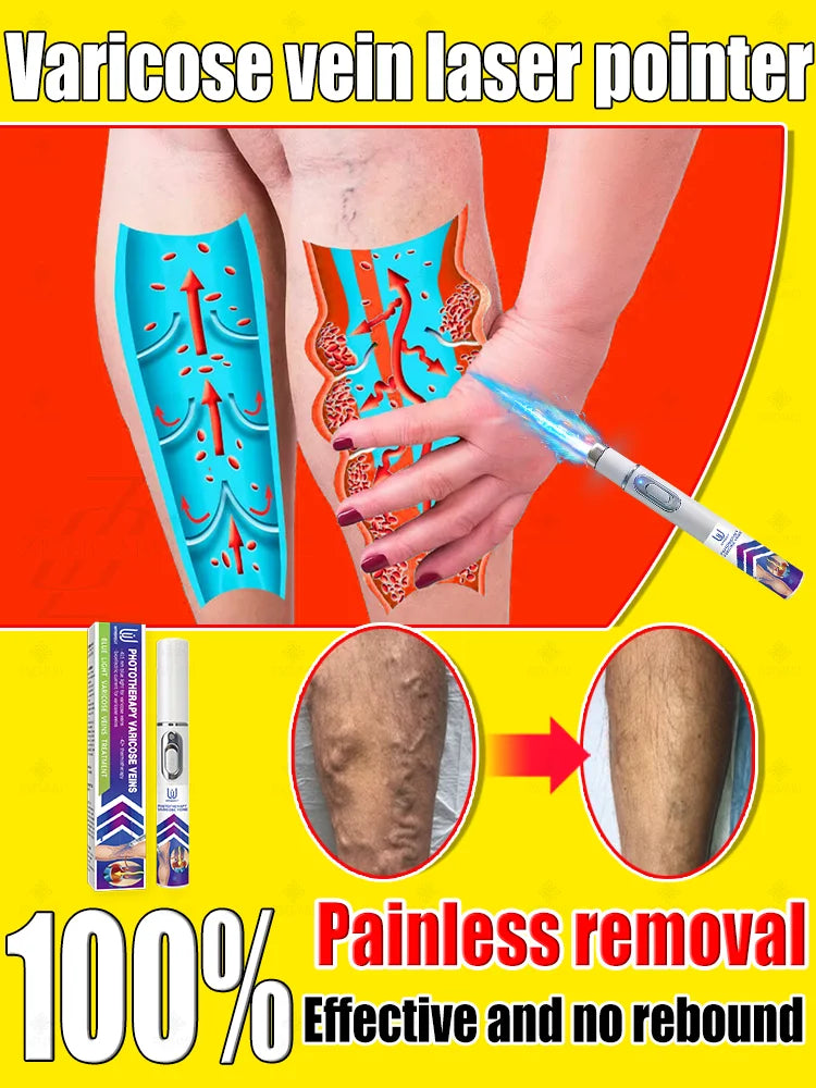 Reverse leg health in 7 days and say goodbye to varicose vein recurrence