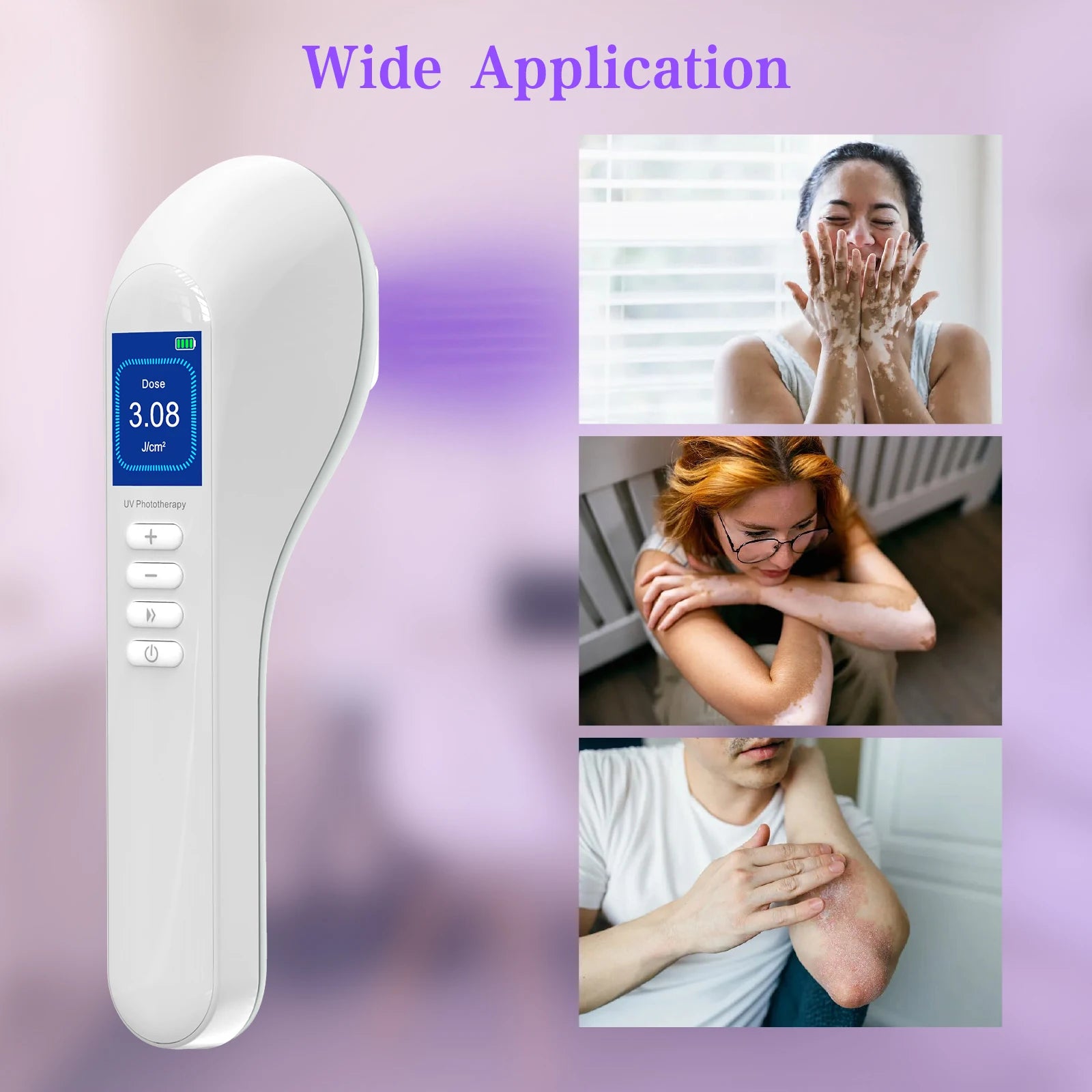 308nm Household Ultraviolet Phototherapy Instrument, Vitiligo Treatment, UVB Lamp Laser for Therapy, Psoriasis, Skin Disease
