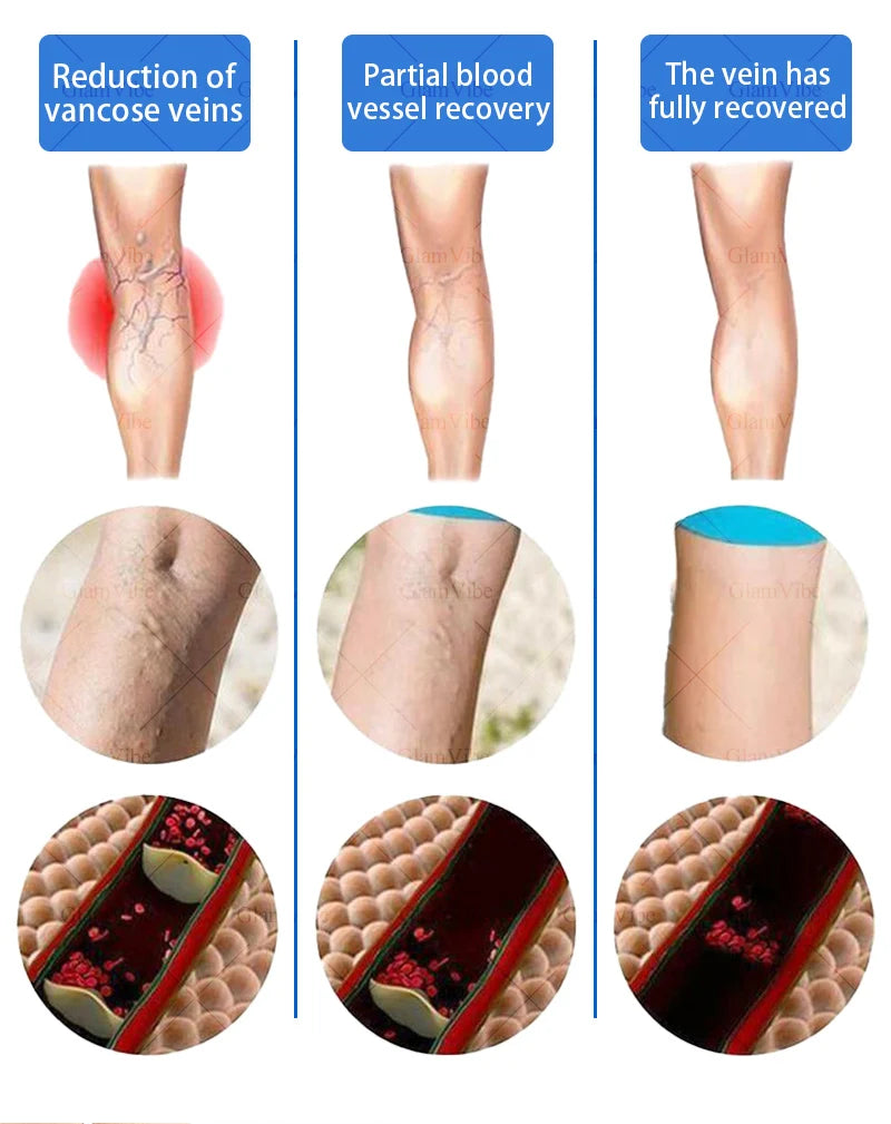 2025 Hᴏᴛ Sᴇʟʟɪɴɢ Pʀᴏᴅᴜᴄᴛs: Vein Leg Massager, Upgraded Second Generation, Blue Light Laser Tool Root Repair