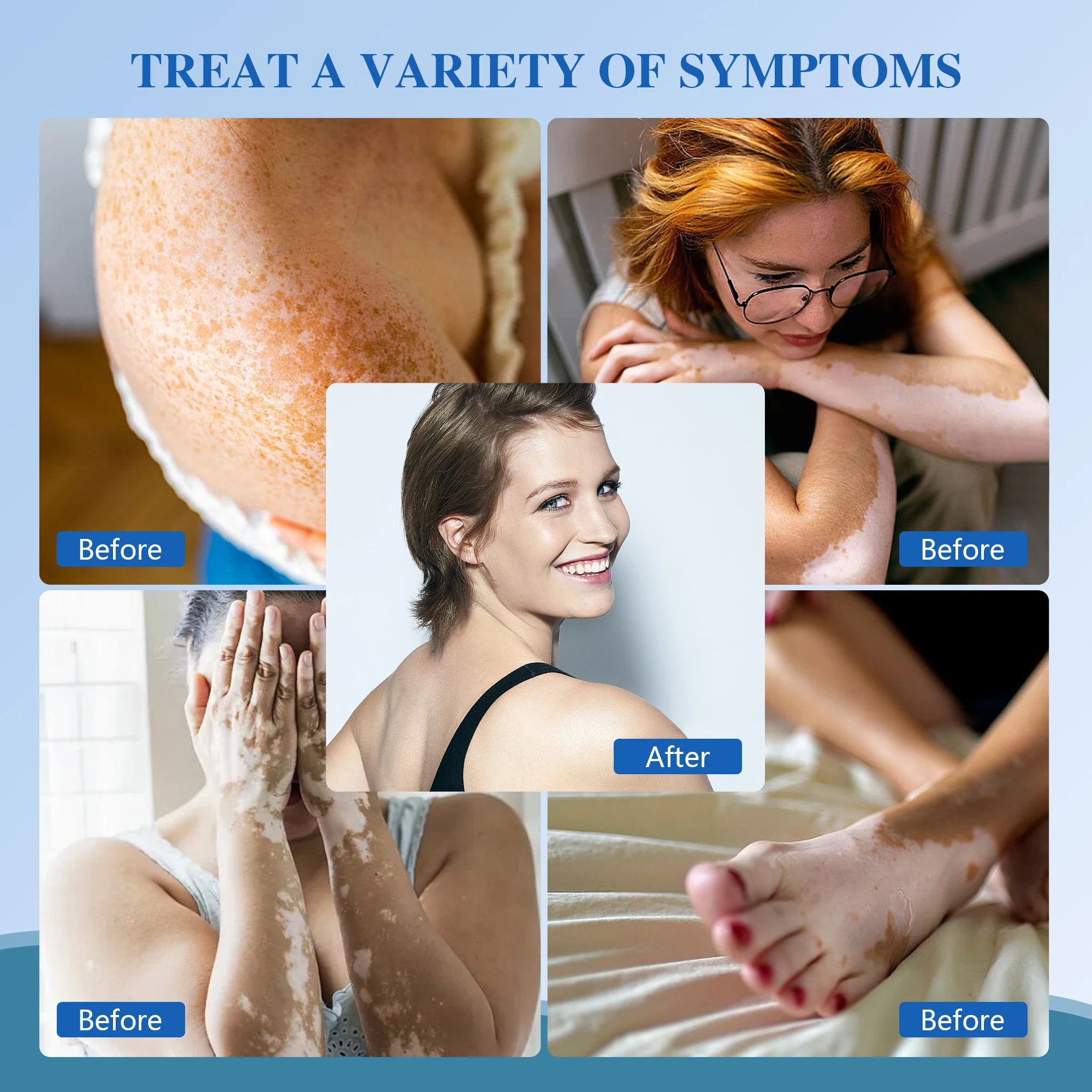 308nm Household Ultraviolet Phototherapy Instrument, Vitiligo Treatment, UVB Lamp Laser for Therapy, Psoriasis, Skin Disease