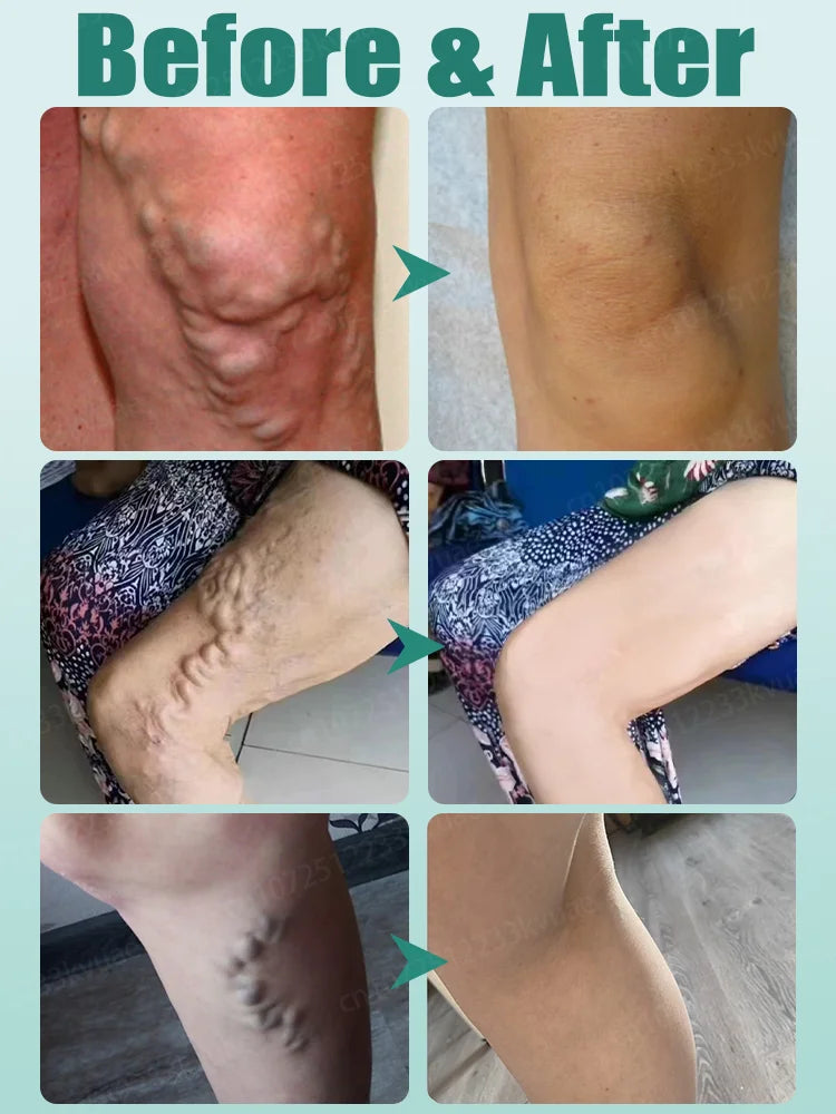 Reverse leg health in 7 days and say goodbye to varicose vein recurrence