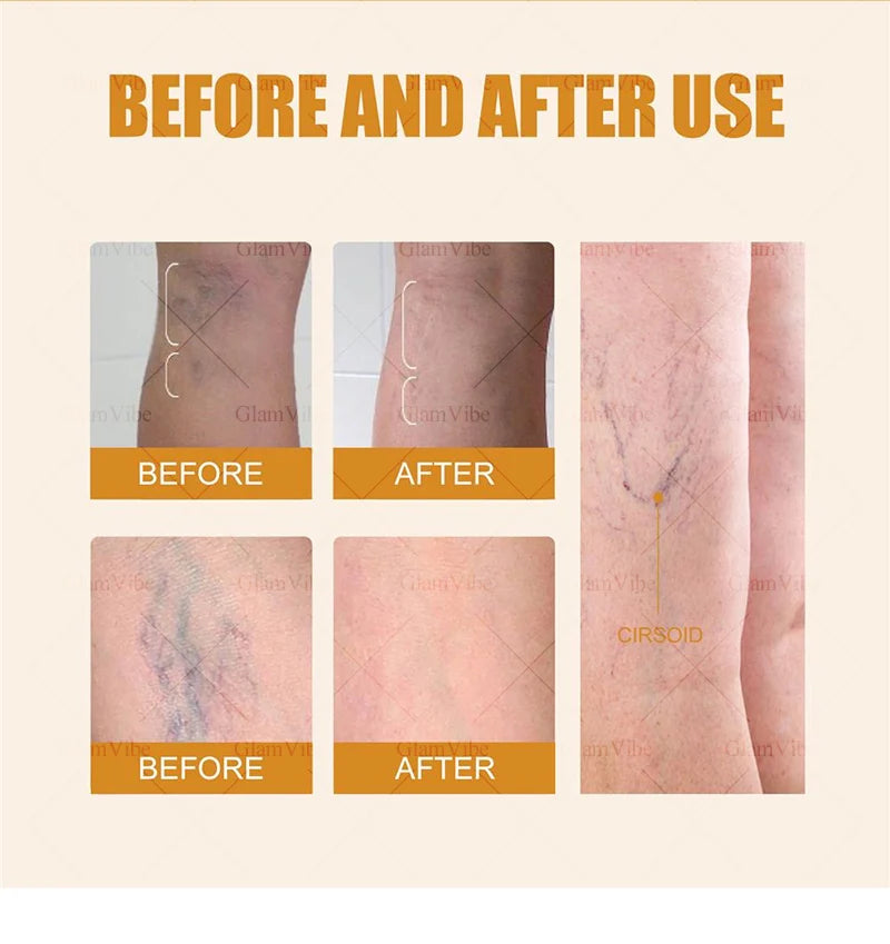 2025 Hᴏᴛ Sᴇʟʟɪɴɢ Pʀᴏᴅᴜᴄᴛs: Vein Leg Massager, Upgraded Second Generation, Blue Light Laser Tool Root Repair