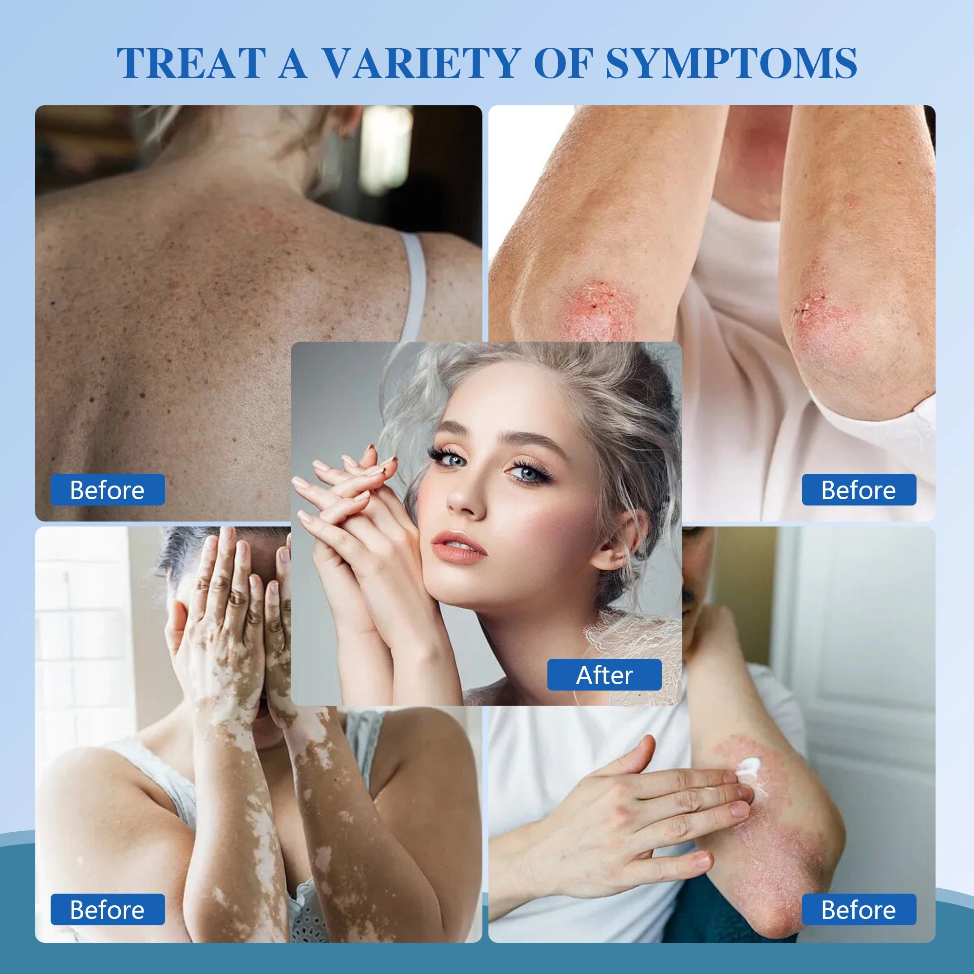 308nm Household Ultraviolet Phototherapy Instrument, Vitiligo Treatment, UVB Lamp Laser for Therapy, Psoriasis, Skin Disease