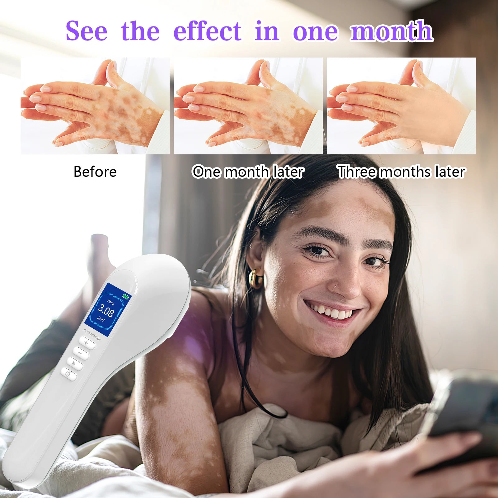 308nm Household Ultraviolet Phototherapy Instrument, Vitiligo Treatment, UVB Lamp Laser for Therapy, Psoriasis, Skin Disease