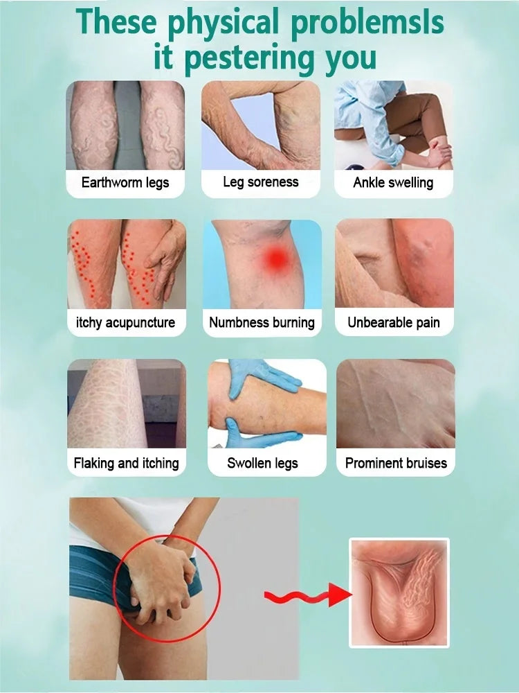 Reverse leg health in 7 days and say goodbye to varicose vein recurrence