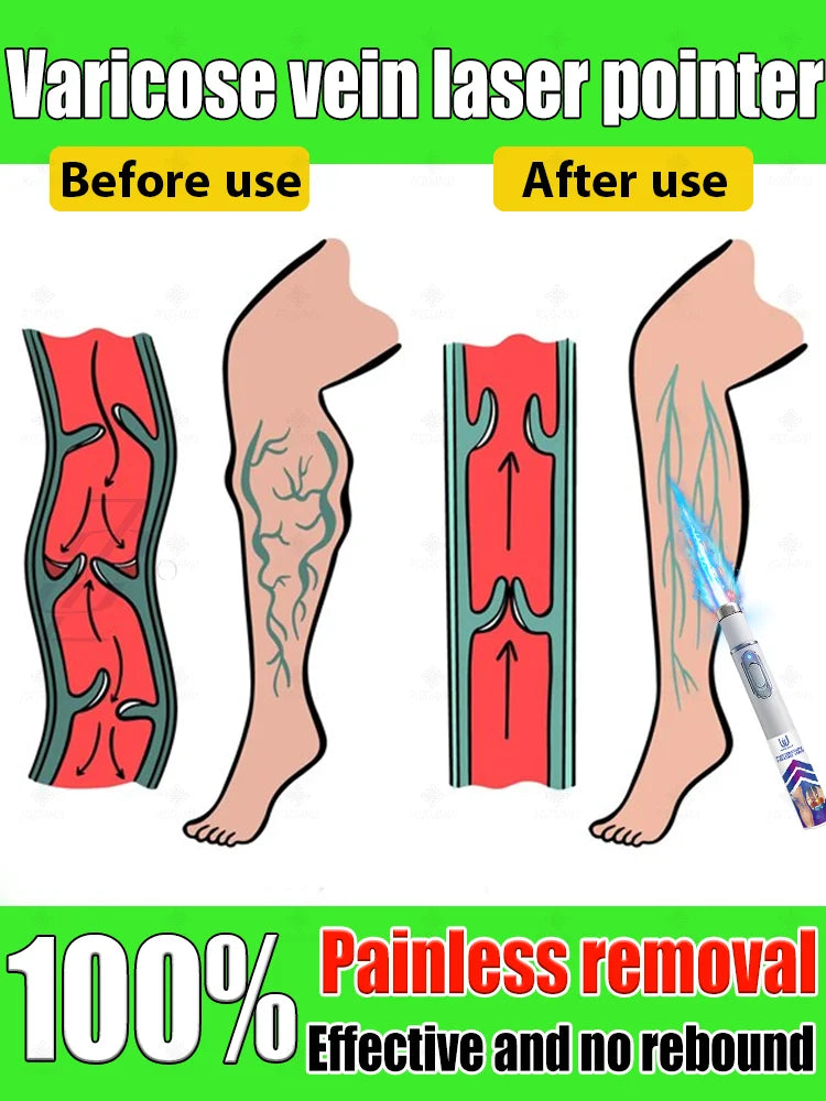 Reverse leg health in 7 days and say goodbye to varicose vein recurrence