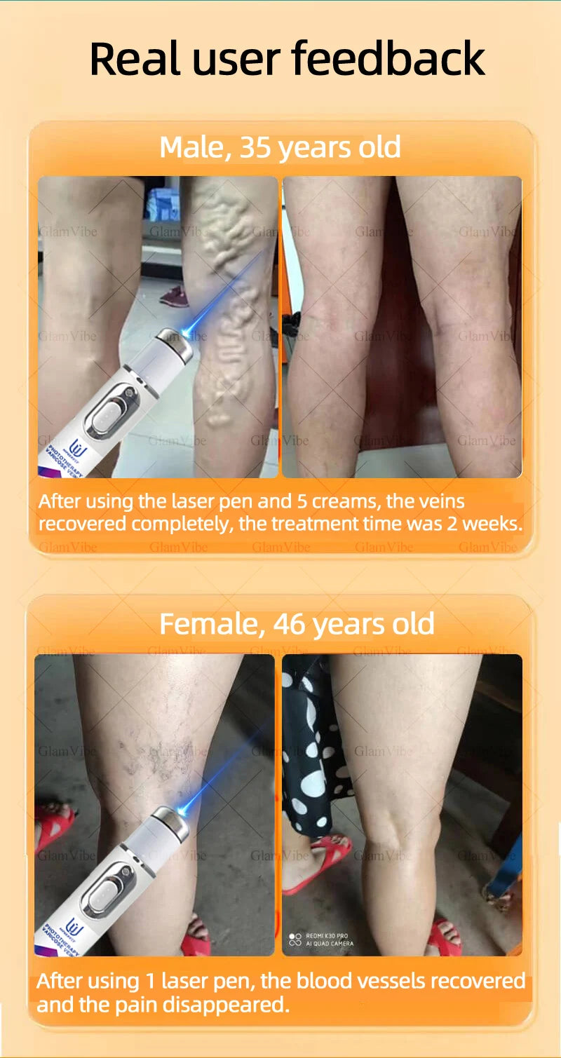 2025 Hᴏᴛ Sᴇʟʟɪɴɢ Pʀᴏᴅᴜᴄᴛs: Vein Leg Massager, Upgraded Second Generation, Blue Light Laser Tool Root Repair