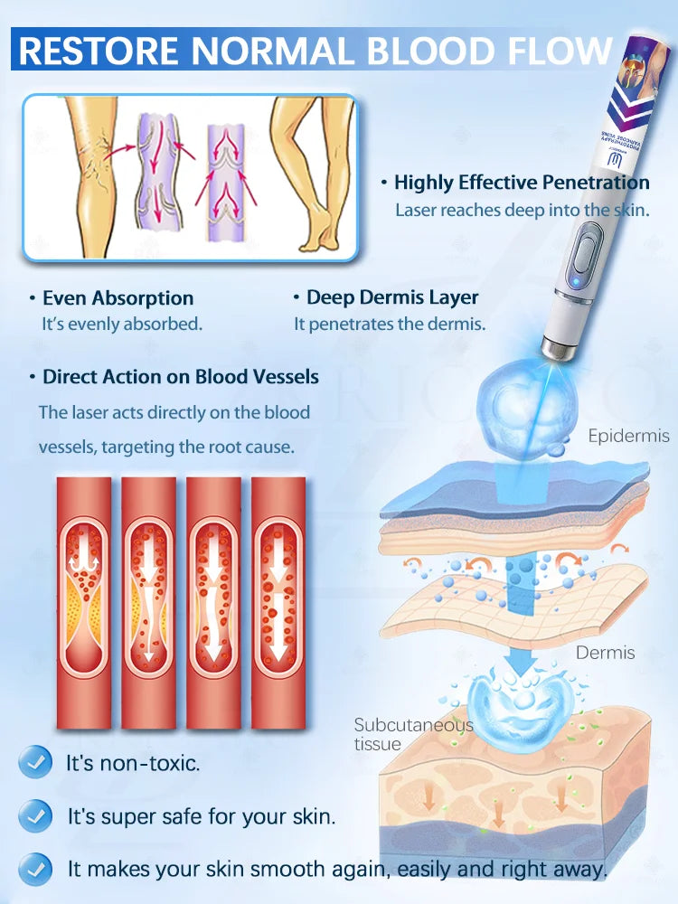 Reverse leg health in 7 days and say goodbye to varicose vein recurrence